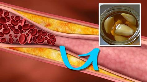 How to Lower Triglycerides Quickly and Naturally - YouTube