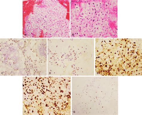 Pathologic histology of sacral chondrosarcoma. (A, B) Microphotography ...