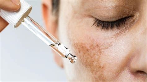 Home Treatments for Eye Hyperpigmentation