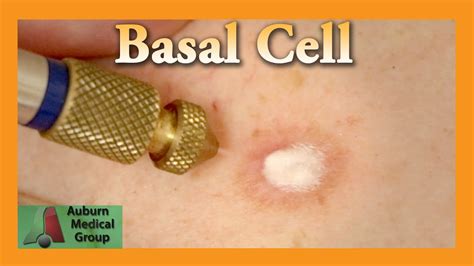 Basal Cell Cryotherapy Treatment | Auburn Medical Group - YouTube