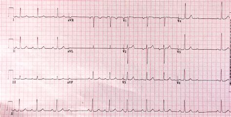 Ecg Showing Mobitz Type Ii Second Degree Av Block Note The Presence Of ...