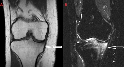 Cureus | Lower Limb Pain Attributed to Bone Marrow Edema Syndrome: A ...