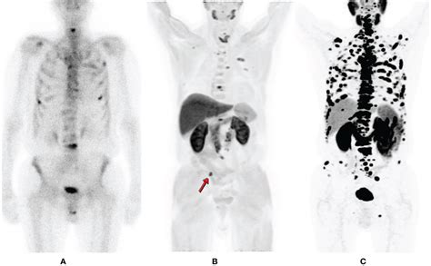 Frontiers | PSMA PET in Imaging Prostate Cancer