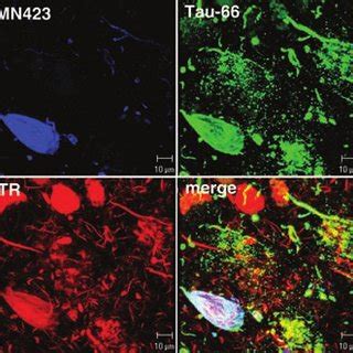 Neurofibrillary Pathology of the Alzheimer's Disease Brain | Download ...