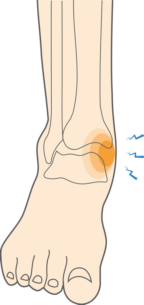 What is a Medial Ankle Sprain & How to Recover from It? - Upswing Health