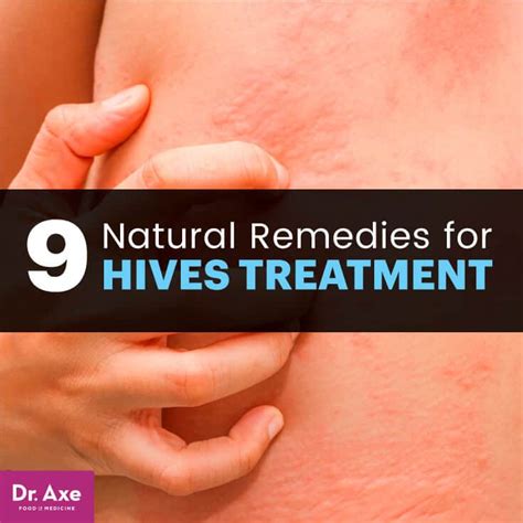 Hives Treatment: 9 Natural Remedies for Soothing Relief - Dr. Axe