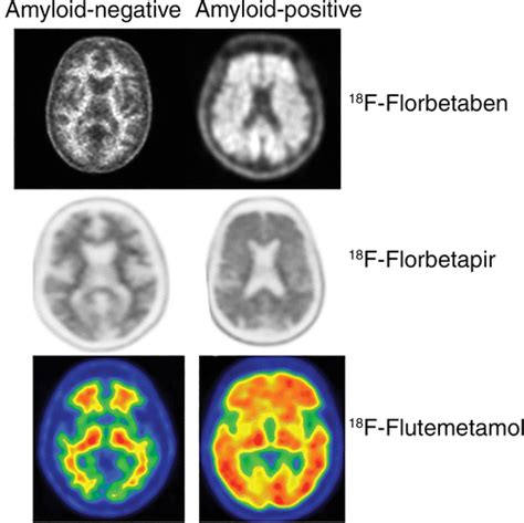 Signs and Artifacts in Amyloid PET | RadioGraphics