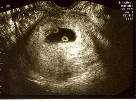 Ultrasound Pictures Of Twins At 5 Weeks - PictureMeta