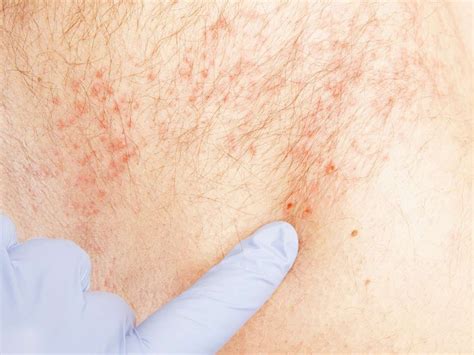 How long does shingles last? Timeline and treatment (With images) | Are ...