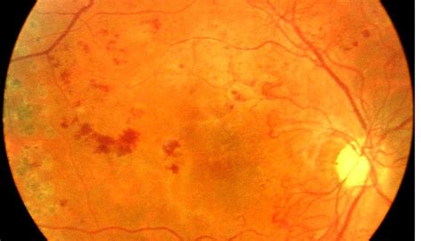 Diabetic retinopathy - Clinical Advisor