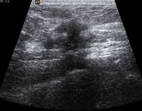 Breast Ultrasound