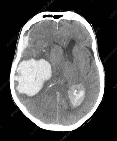 Massive Intracranial Hemorrhage, CT Scan - Stock Image - C027/1775 ...