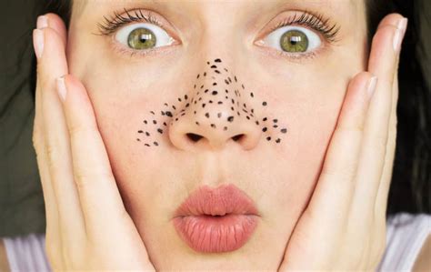 5 Ultimate Tips to Get Rid of Blackheads