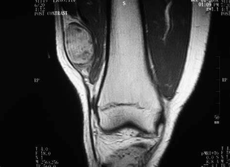 Synovial Sarcoma: Soft Tissue Sarcoma