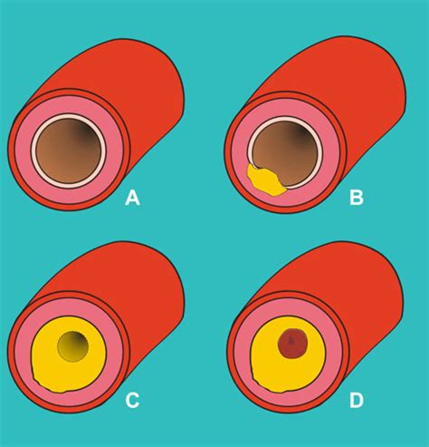 Simplified diagram of the development of atherosclerosis showing: Cross ...