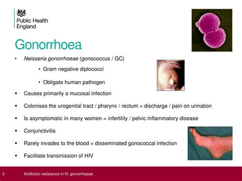 PPT - Antibiotic resistance in Neisseria gonorrhoeae PowerPoint ...