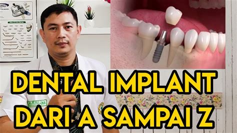 Proses pemasangan implan gigi-gigi implan-implant gigi - YouTube