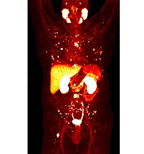 PSMA PET Scan for Prostate Cancer - UChicago Medicine