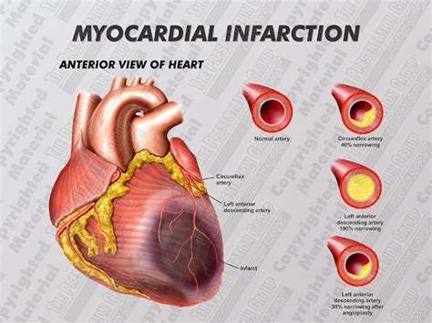 Myocardial infarction (MI)