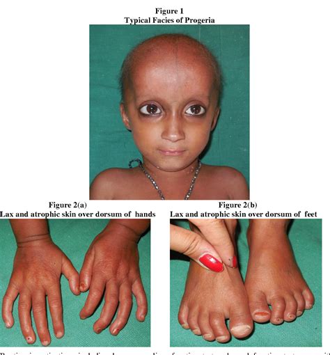 Werner Syndrome Progeria Adult