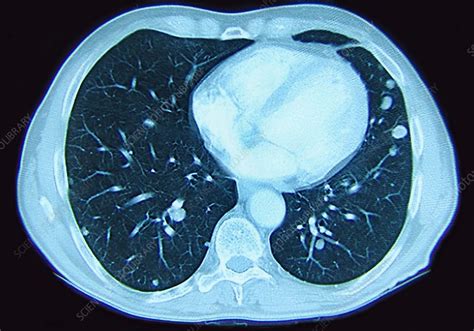 Lung Metastases - Stock Image - C027/0968 - Science Photo Library