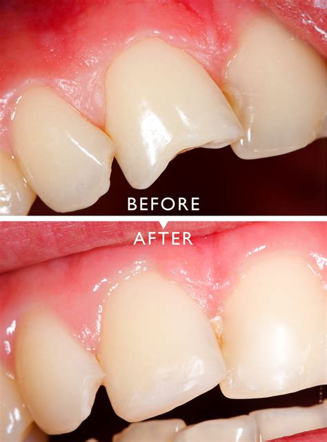 Cracked, Chipped, Broken Tooth Repair - Two Rivers Family Dentistry