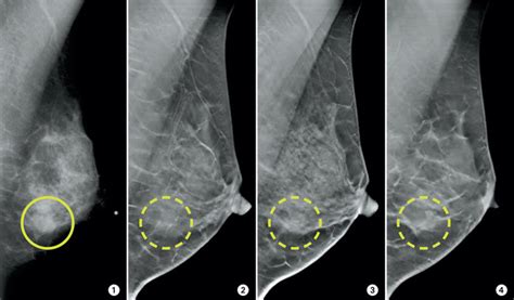 3-D mammograms may improve accuracy of breast cancer screening | Centre ...