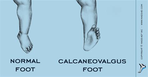 What Is A Calcaneovalgus Foot? - MASS4D® Foot Orthotics