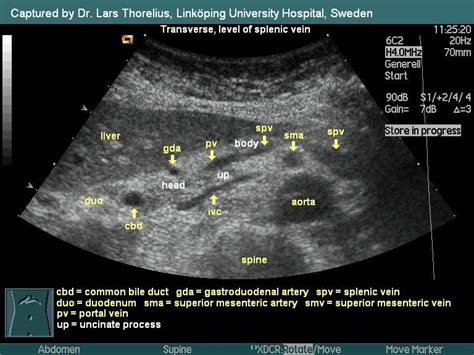 Bedside ultrasound for acute appendicitis featuring colorized images ...