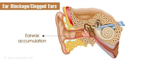 Clogged Ears: Causes, Picture, Symptoms And Treatment