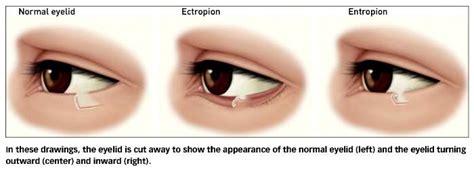 Eyelid Surgery