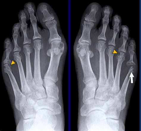 Rheumatoid Arthritis X Ray Knee