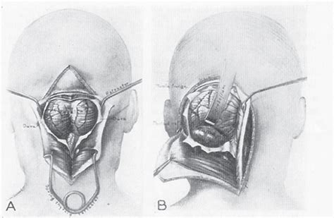 Surgery of the Posterior Cranial Fossa: Historical Aspects | Neupsy Key