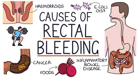 Understanding Rectal Bleeding: Causes and Management