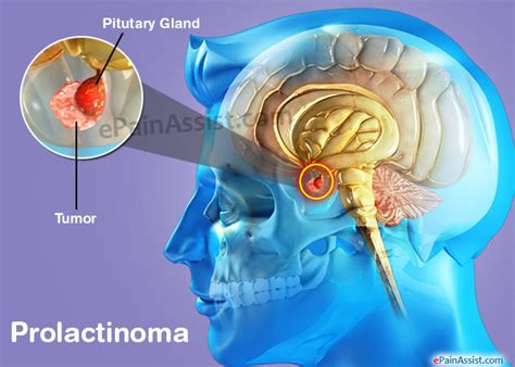 What is a prolactinoma and how can it affect a person’s sexual function ...