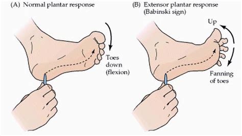 Primitive Reflexes Part 1 - YouTube