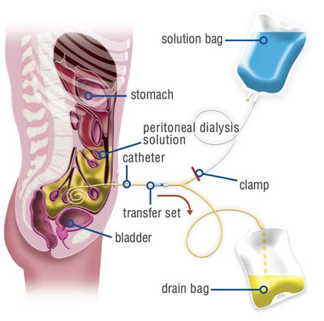 Baxter Home Dialysis Machine Manual - Home Alqu