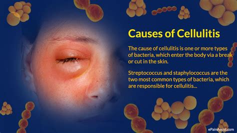 Cellulitis (Infections) - Apex Dermatology & Skin Surgery