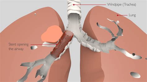 Bronchoscopy | Thoracic Surgery University Hospitals Birmingham