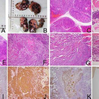 (A). Grossly, the anterior mediastinal mass resembled an enlarged ...