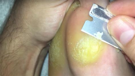 This Foot Callus Removal YouTube Channel Is Equally Disgusting and ...