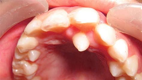 Hyperdontia Causes