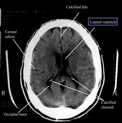 Cat Scan Brain Tumor