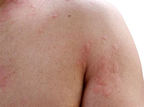 Hives symptoms and treatments - Dermatology Boca Raton Dermatologist ...