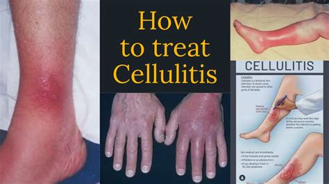 iv antibiotics for cellulitis - YouTube