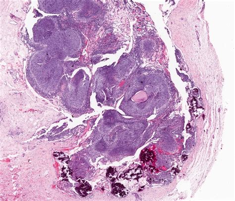 Pathology Outlines - Adenomatoid odontogenic tumor