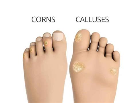 What is Corns and Calluses: Types, Symptoms, and Causes ...