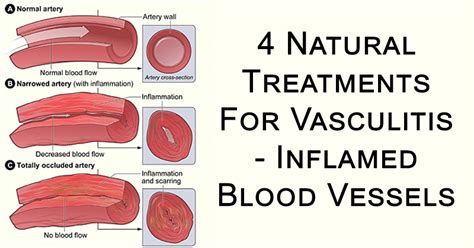 Vasculitis Symptoms