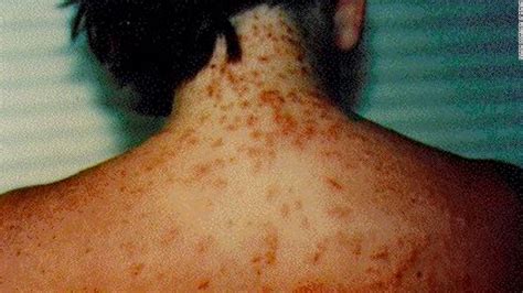 'Sea lice' rash caused by baby jellyfish stings - CNN