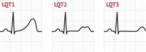 Congenital Long QT Syndrome | ECG Disease Patterns - MedSchool